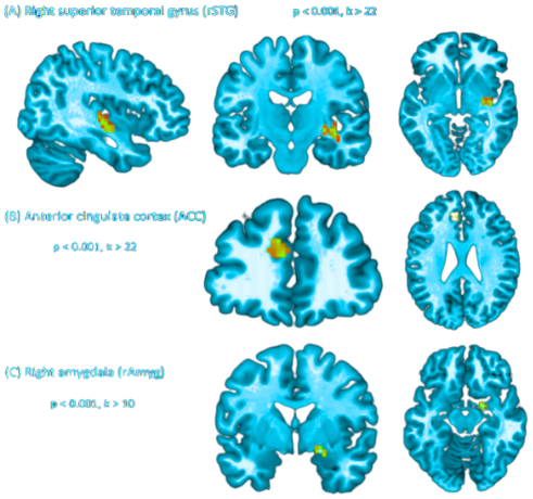 Brain scans showing activation in the right superior temporal gyrus, anterior cingulate cortex and right amygdala after 12 Hz infrasound